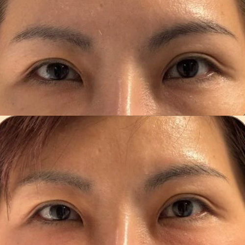 膠原蛋白熊貓針